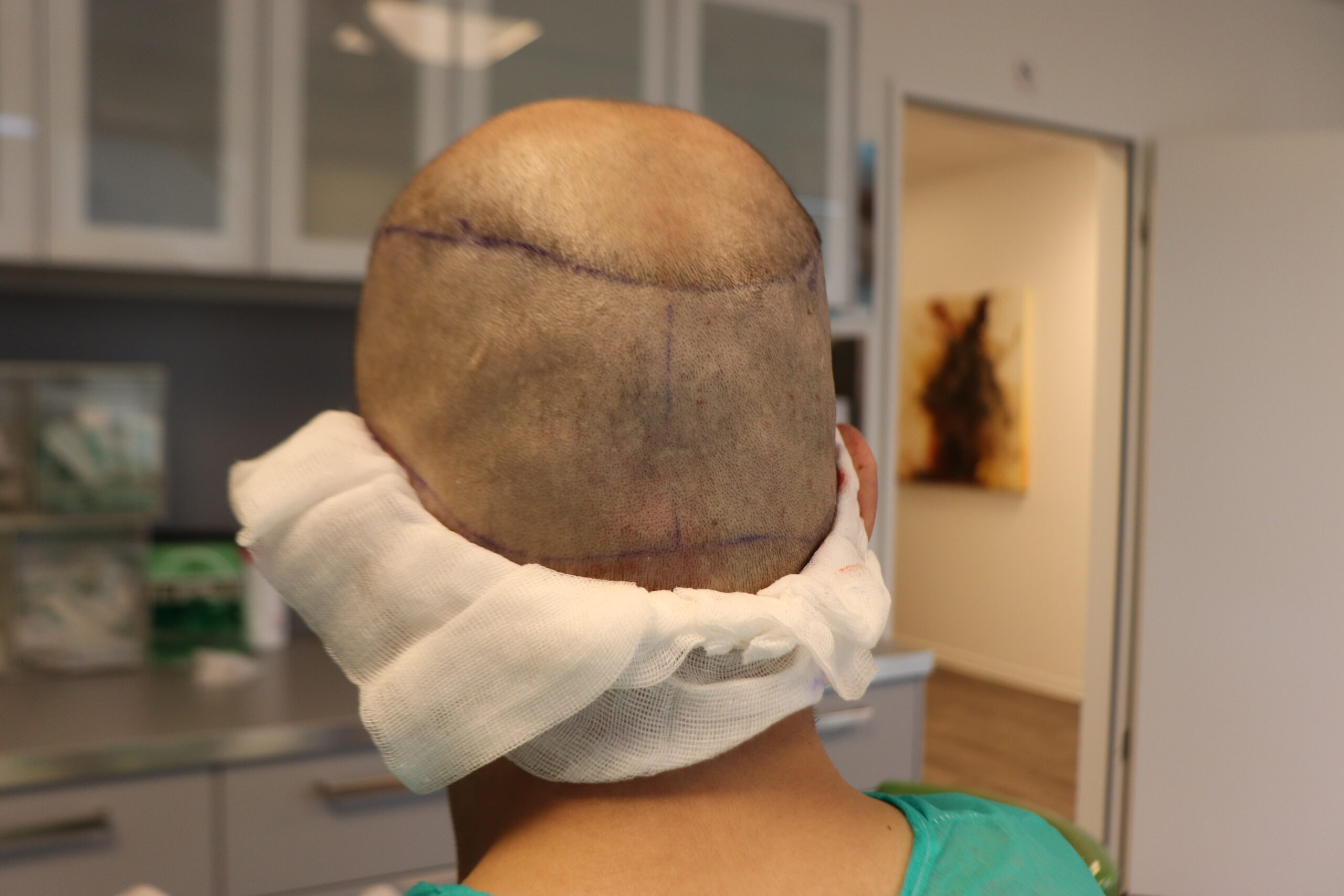 Anzeichnen FUE Haartransplantation bei Dr. Afshin