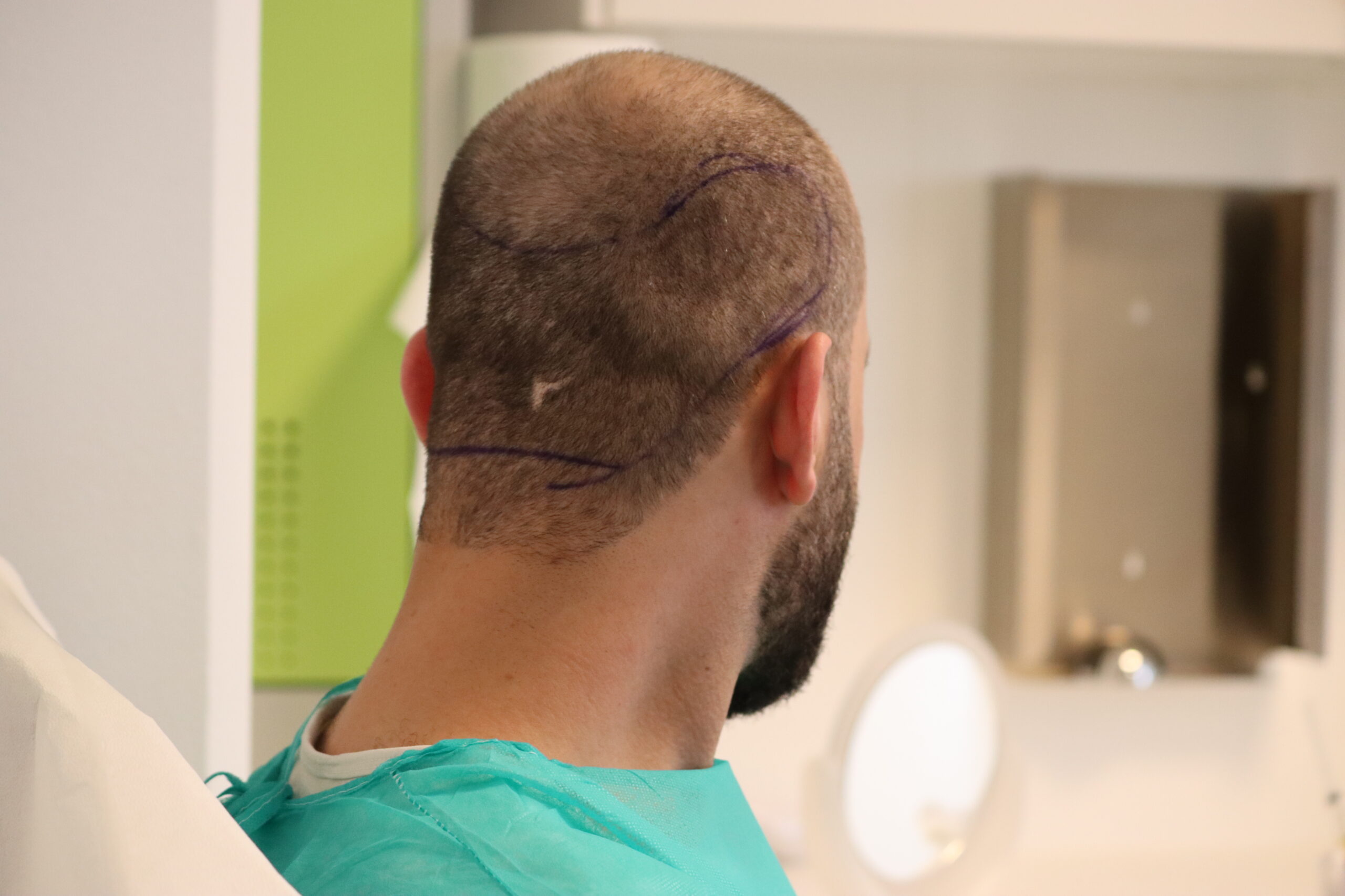 Anzeichnen FUE Haartransplantation bei Dr. Afshin