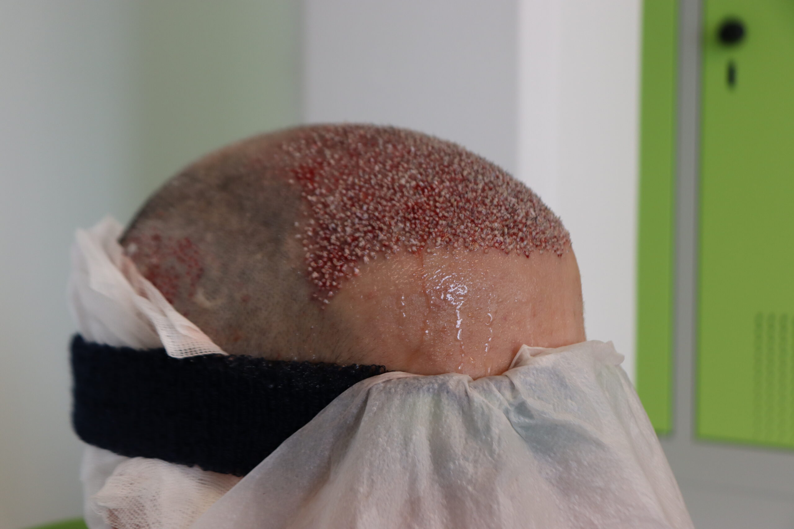 FUE Haartransplantation bei Dr. Afshin